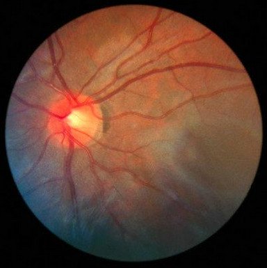 fundoscopy2